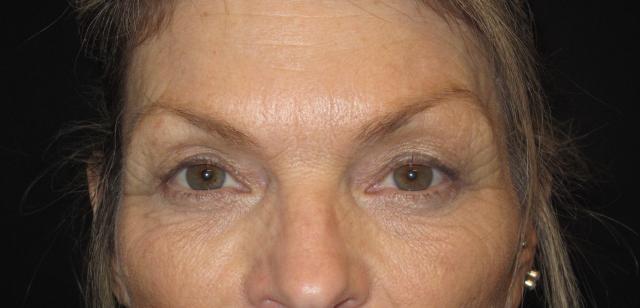 Blepharoplasty before at Kramer Plastic Surgery in Meridian, ID
