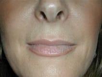 Juvederm before at Kramer Plastic Surgery in Meridian, ID