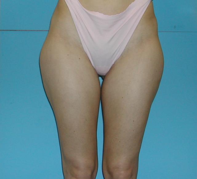 Brazilian Butt Lift before at Kramer Plastic Surgery in Meridian, ID