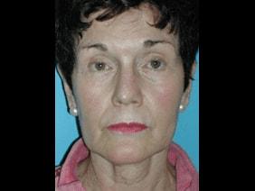 Facelift before at Kramer Plastic Surgery in Meridian, ID