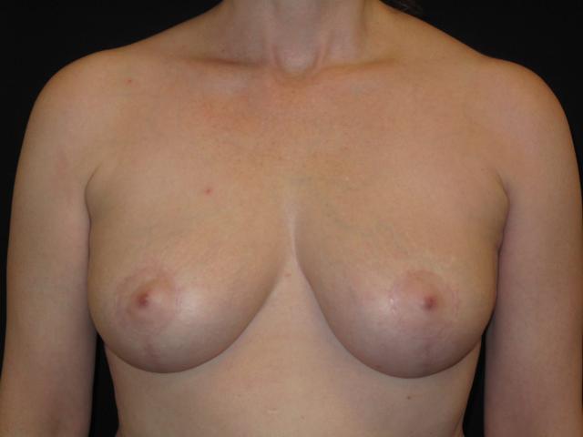 Breast Lift after at Kramer Plastic Surgery in Meridian, ID