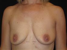 Breast Lift before at Kramer Plastic Surgery in Meridian, ID