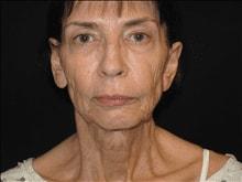 Mini Facelift before at Kramer Plastic Surgery in Meridian, ID