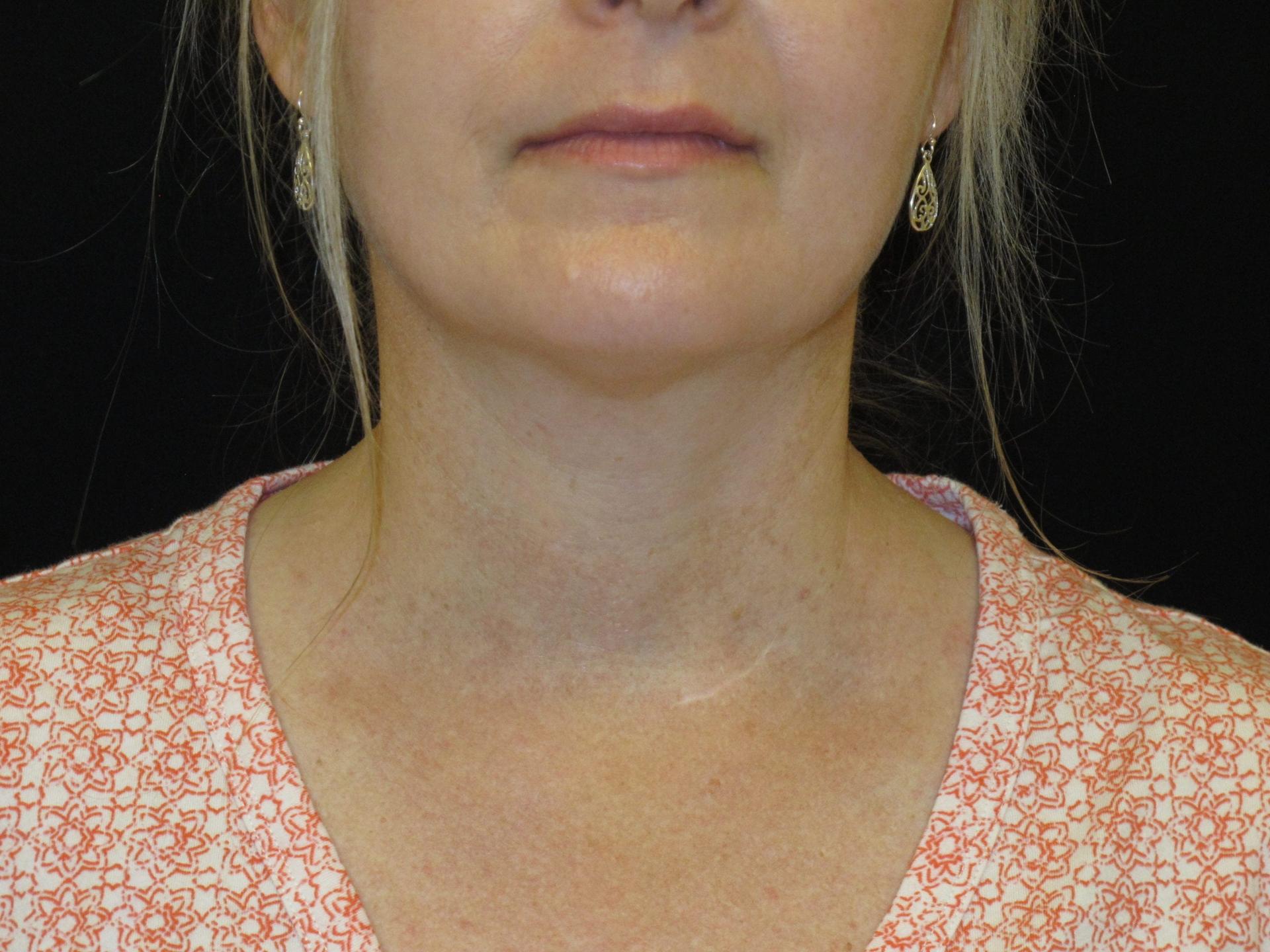 Kramer Plastic Surgery double chin treatment after — Meridian, ID
