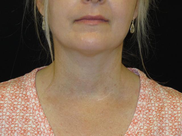 Kybella after at Kramer Plastic Surgery in Meridian, ID