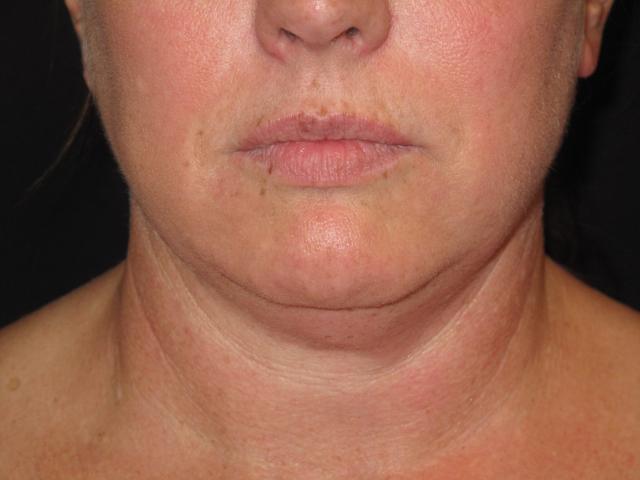 Kybella before at Kramer Plastic Surgery in Meridian, ID