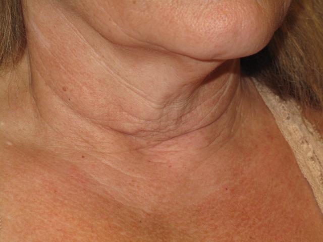 Facelift before at Kramer Plastic Surgery in Meridian, ID