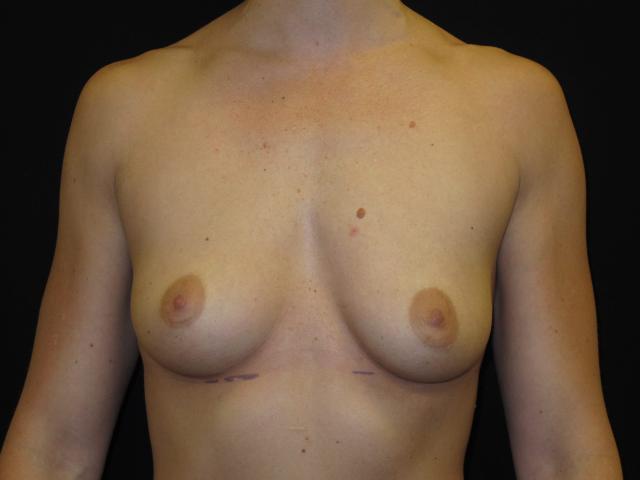 Fat Transfer Breast Augmentation before at Kramer Plastic Surgery in Meridian, ID