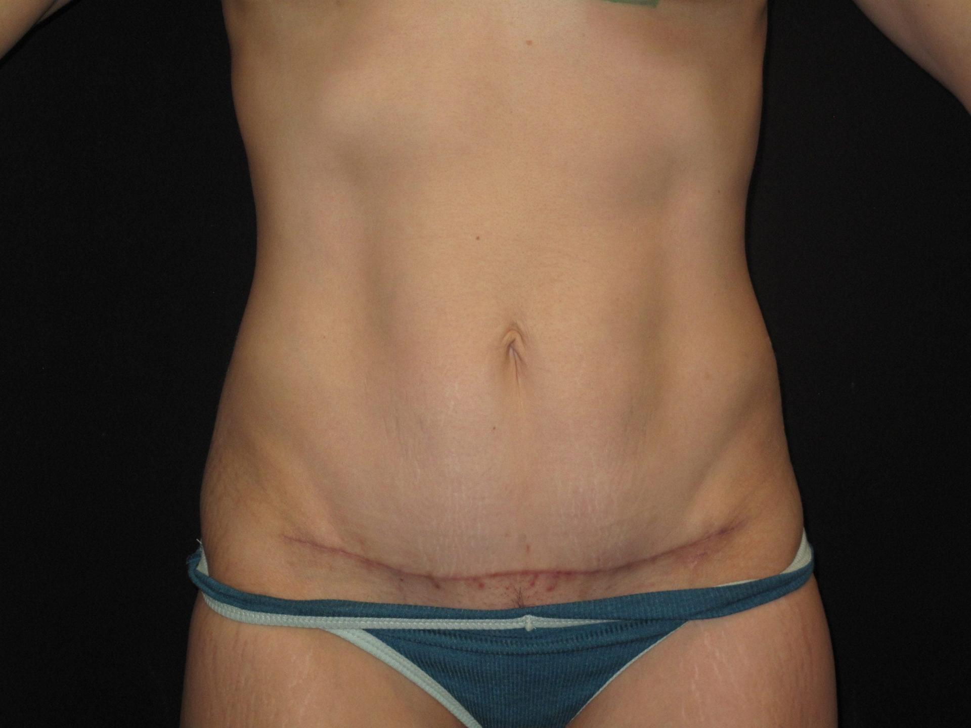 Kramer Plastic Surgery tummy tuck after — Meridian, ID
