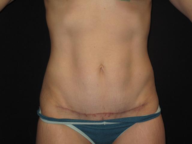 Mini Tummy Tuck after at Kramer Plastic Surgery in Meridian, ID