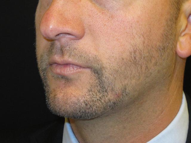 Chin Implant after at Kramer Plastic Surgery in Meridian, ID