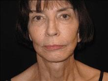 Mini Facelift after at Kramer Plastic Surgery in Meridian, ID
