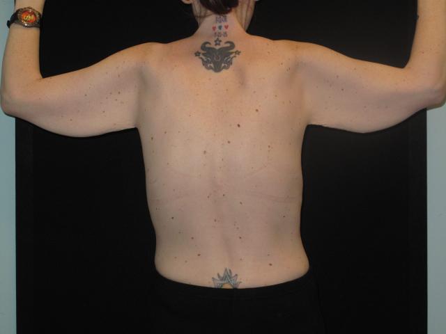 Arm Lift before at Kramer Plastic Surgery in Meridian, ID