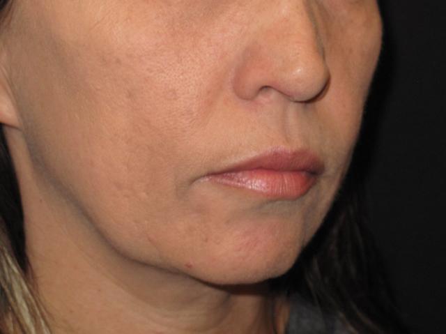 Chin Implant before at Kramer Plastic Surgery in Meridian, ID