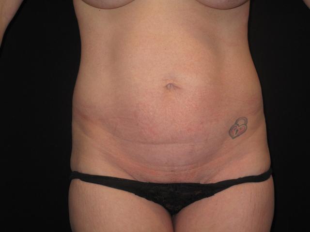 Mommy Makeover before at Kramer Plastic Surgery in Meridian, ID