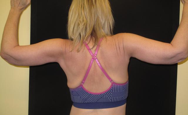 Arm Lift after at Kramer Plastic Surgery in Meridian, ID