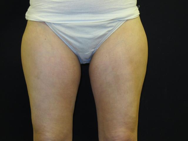 Thigh Lift after at Kramer Plastic Surgery in Meridian, ID