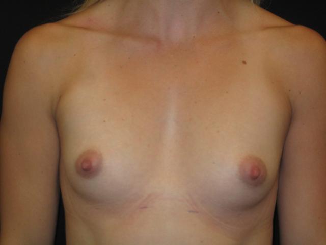Fat Transfer Breast Augmentation before at Kramer Plastic Surgery in Meridian, ID