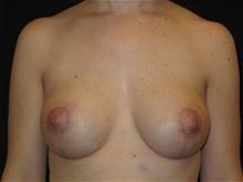 Breast Lift after at Kramer Plastic Surgery in Meridian, ID