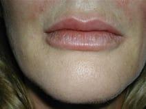Juvederm after at Kramer Plastic Surgery in Meridian, ID