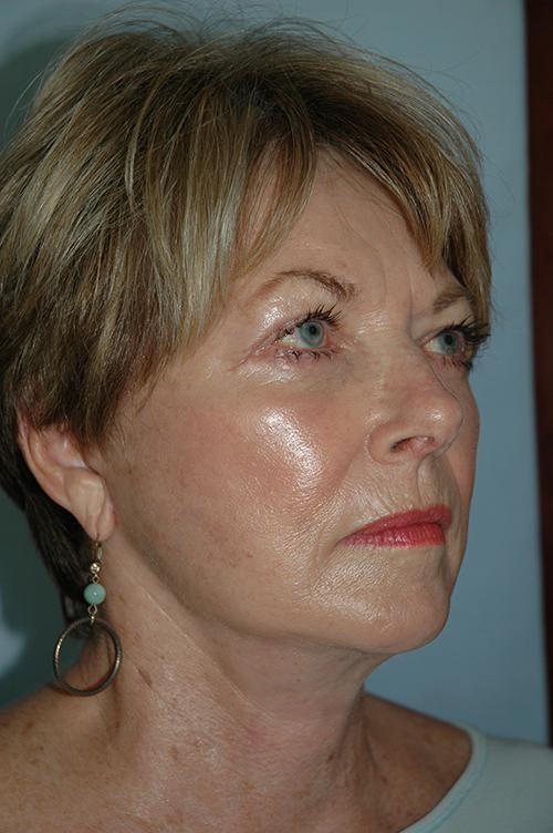 Gardner Facial Plastic Surgery facelift after — St. George, UT