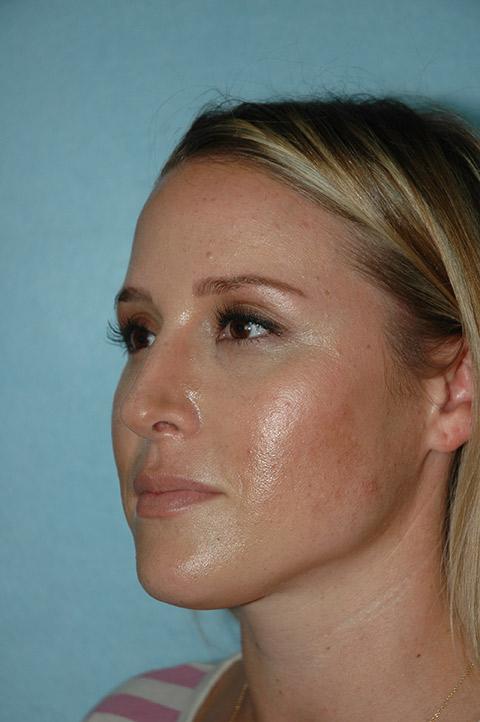 Gardner Facial Plastic Surgery rhinoplasty after — St. George, UT