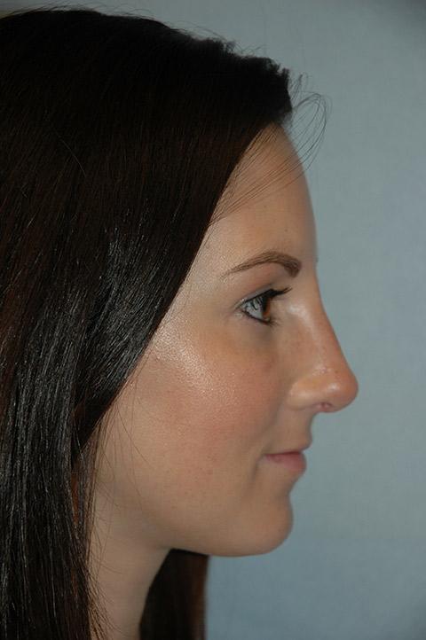 Functional Rhinoplasty after at Gardner Facial Plastic Surgery in St. George, UT