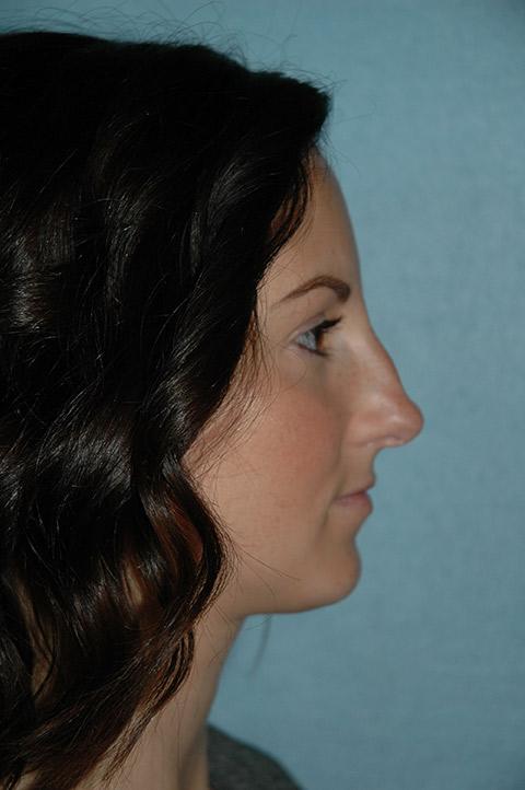 Functional Rhinoplasty before at Gardner Facial Plastic Surgery in St. George, UT