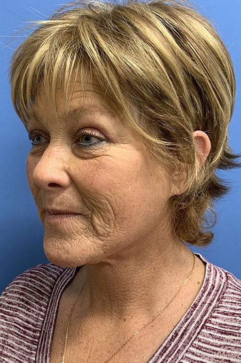 Deep Plane Facelift after at Gardner Facial Plastic Surgery in St. George, UT