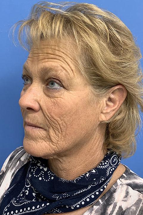 Deep Plane Facelift before at Gardner Facial Plastic Surgery in St. George, UT