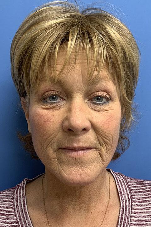 Gardner Facial Plastic Surgery facelift after — St. George, UT