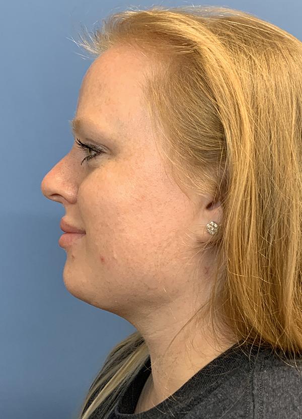 Neck Lift after at Gardner Facial Plastic Surgery in St. George, UT