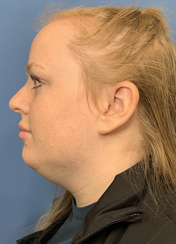 Neck Lift before at Gardner Facial Plastic Surgery in St. George, UT