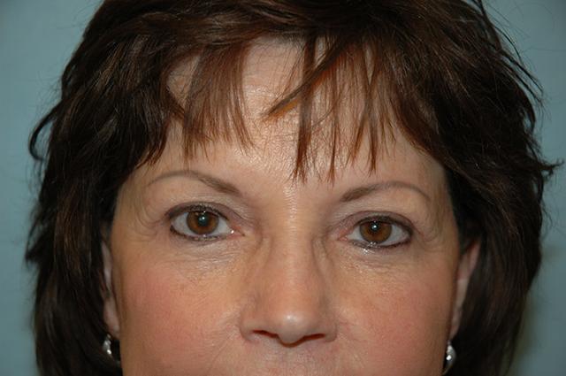 Blepharoplasty after at Gardner Facial Plastic Surgery in St. George, UT