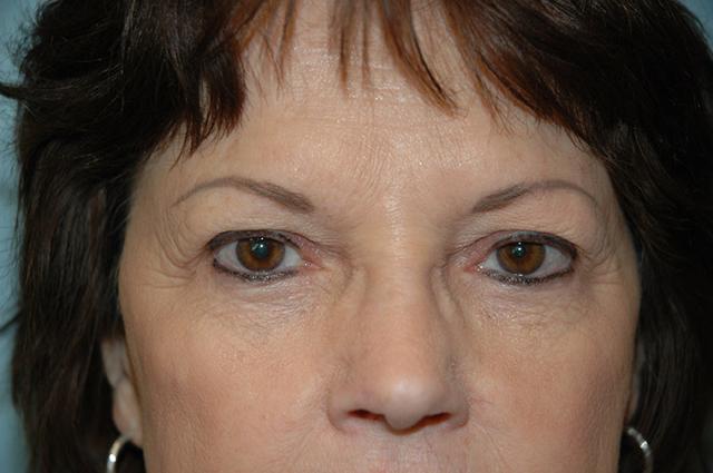 Blepharoplasty before at Gardner Facial Plastic Surgery in St. George, UT