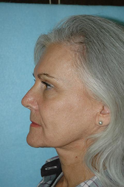 Gardner Facial Plastic Surgery facelift after — St. George, UT