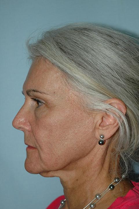 Facelift before at Gardner Facial Plastic Surgery in St. George, UT