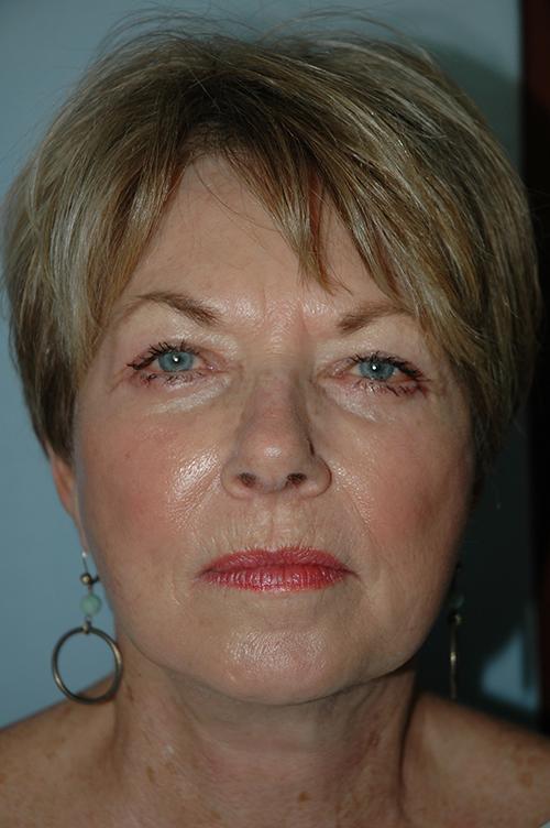 Gardner Facial Plastic Surgery facelift after — St. George, UT