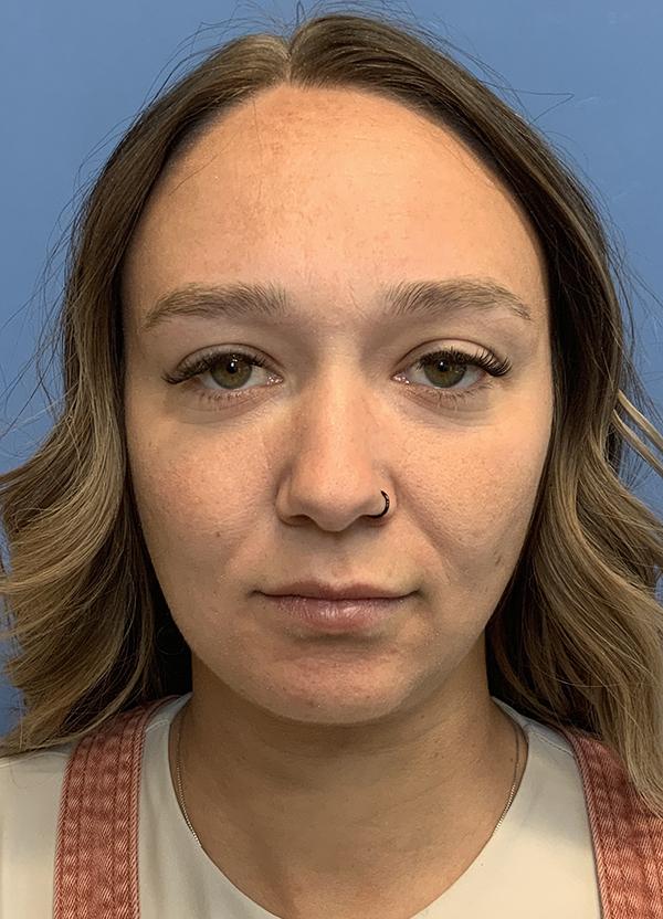 Neck Lift after at Gardner Facial Plastic Surgery in St. George, UT