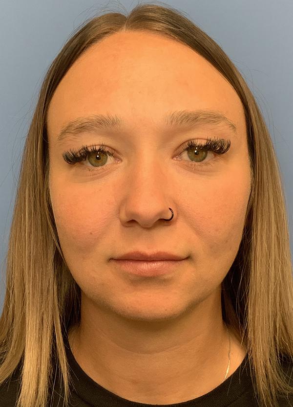 Neck Lift before at Gardner Facial Plastic Surgery in St. George, UT