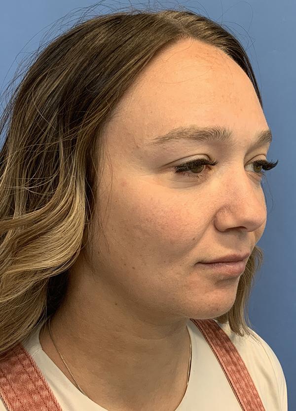 Neck Lift after at Gardner Facial Plastic Surgery in St. George, UT