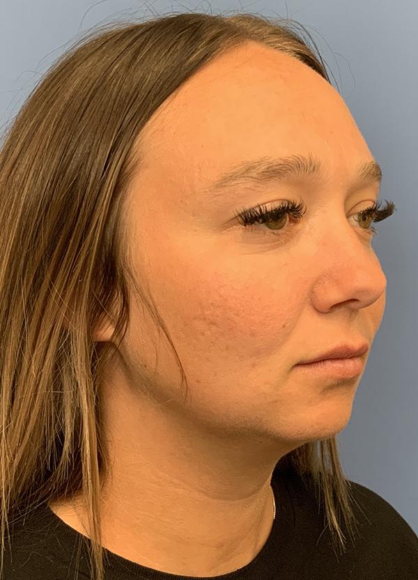 Neck Lift before at Gardner Facial Plastic Surgery in St. George, UT