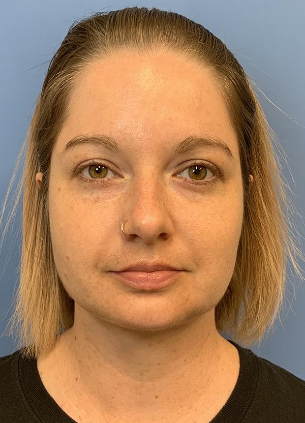 Gardner Facial Plastic Surgery neck lift after — St. George, UT