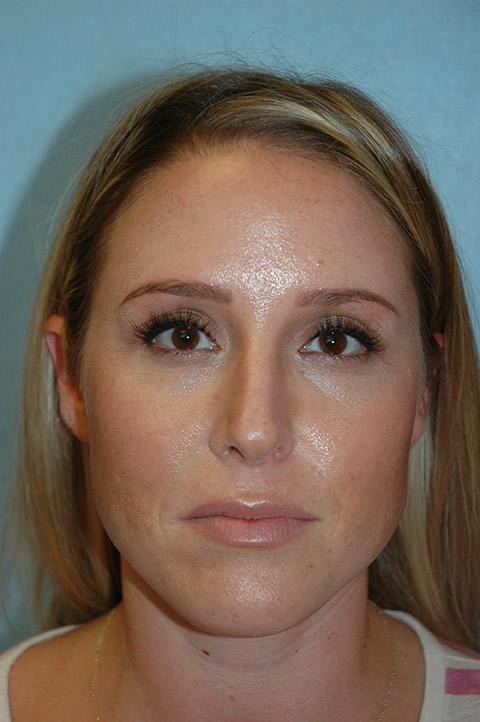 Gardner Facial Plastic Surgery rhinoplasty after — St. George, UT