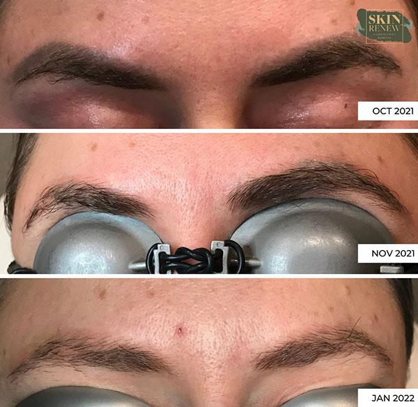 Laser Skin Resurfacing result at Skin Renew Day Spa & Laser Center in Indianapolis, IN