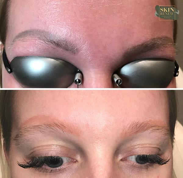 Skin Renew Day Spa & Laser Center result — Indianapolis, IN