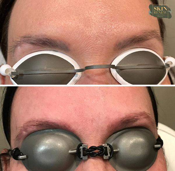 Skin Renew Day Spa & Laser Center laser treatment result — Indianapolis, IN