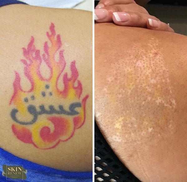 Skin Renew Day Spa & Laser Center result — Indianapolis, IN