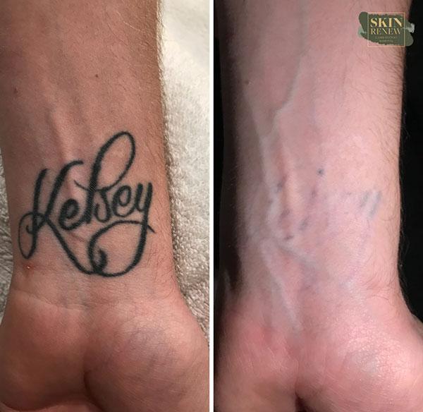 Skin Renew Day Spa & Laser Center result — Indianapolis, IN