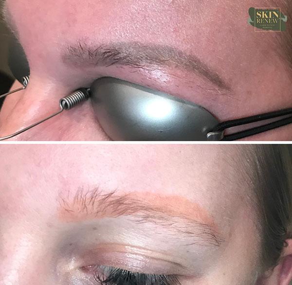 Skin Renew Day Spa & Laser Center result — Indianapolis, IN